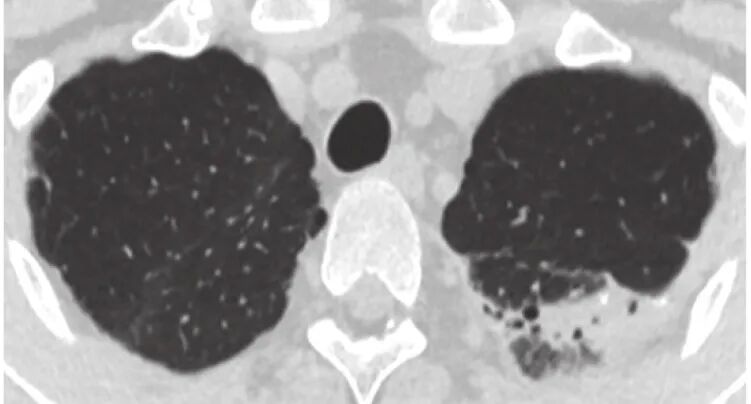 abp 统计怎么做变应性支气管肺曲霉病临床特点及基础疾病分析_https://www.jmylbn.com_新闻资讯_第9张