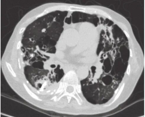 abp 统计怎么做变应性支气管肺曲霉病临床特点及基础疾病分析_https://www.jmylbn.com_新闻资讯_第8张