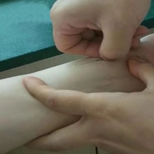 失眠？疼痛？特色疗法腕踝针一招搞定