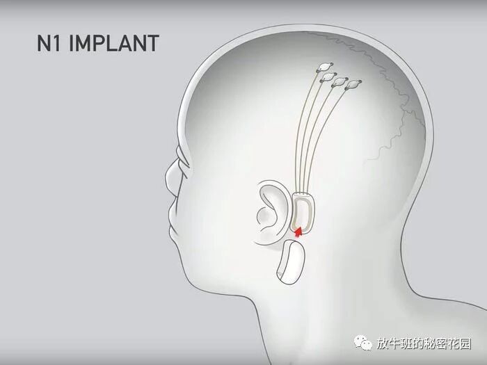 《马斯克称Neuralink大脑芯片将治愈自闭症》