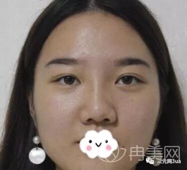 广州壹加壹整形价格表全新版19 附鼻综合恢复靓照 三元网3ua 微信公众号文章阅读 Wemp