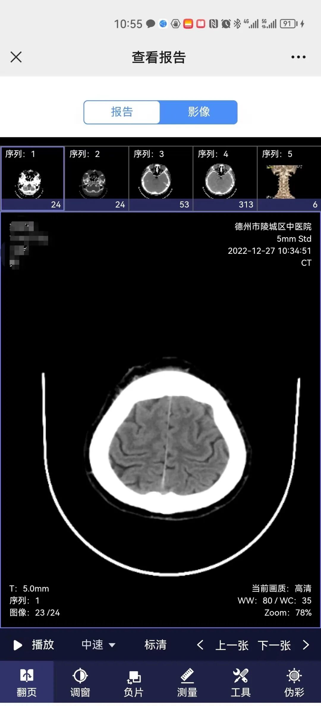 医用ct胶片怎么收纳“云胶片”太方便，查看结果一部手机就够了！CT、磁共振影像报告可存手机带走_https://www.jmylbn.com_新闻资讯_第13张
