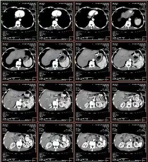 医用ct胶片怎么收纳“云胶片”太方便，查看结果一部手机就够了！CT、磁共振影像报告可存手机带走_https://www.jmylbn.com_新闻资讯_第2张