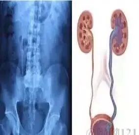 猪尾巴导管怎么拔出【科普】泌尿外科的猪尾巴_https://www.jmylbn.com_新闻资讯_第14张