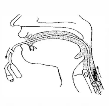医讯怎么用【医讯】“如鲠在喉”到“畅通无阻” ——吞咽障碍之球囊扩张术的应用_https://www.jmylbn.com_新闻资讯_第5张