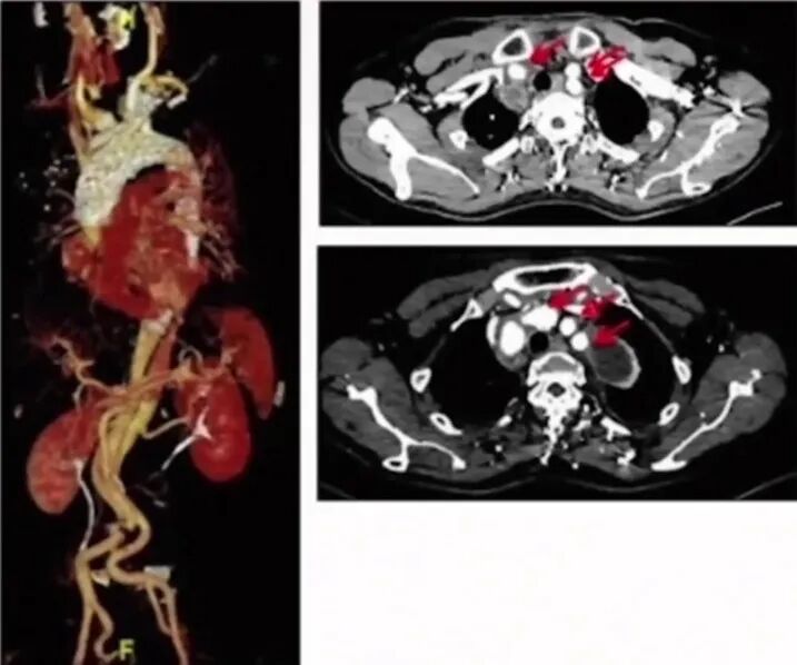 波科支架怎么样陆信武：激光原位开窗重建弓上分支治疗A型主动脉夹层_https://www.jmylbn.com_新闻资讯_第12张