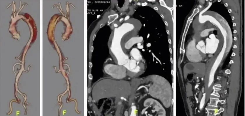 波科支架怎么样陆信武：激光原位开窗重建弓上分支治疗A型主动脉夹层_https://www.jmylbn.com_新闻资讯_第3张