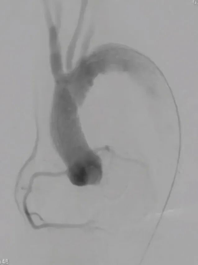 波科支架怎么样陆信武：激光原位开窗重建弓上分支治疗A型主动脉夹层_https://www.jmylbn.com_新闻资讯_第9张