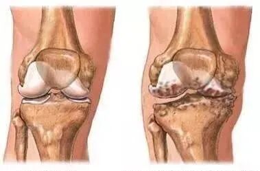 只用一副药，走路虎虎生风，揭秘中医治疗膝盖疼痛的专用方，一敷就见效