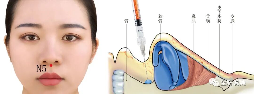 鼻部安全注射 从解剖及注射方式预防鼻部栓塞 全轩课堂 微信公众号文章阅读 Wemp