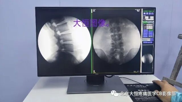 c臂机怎么关机C型臂X光机定义：_https://www.jmylbn.com_新闻资讯_第3张