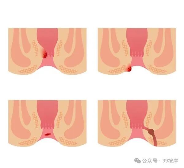 痔疮患者请管住嘴！这几种食物是“加重剂”，再馋也要忍