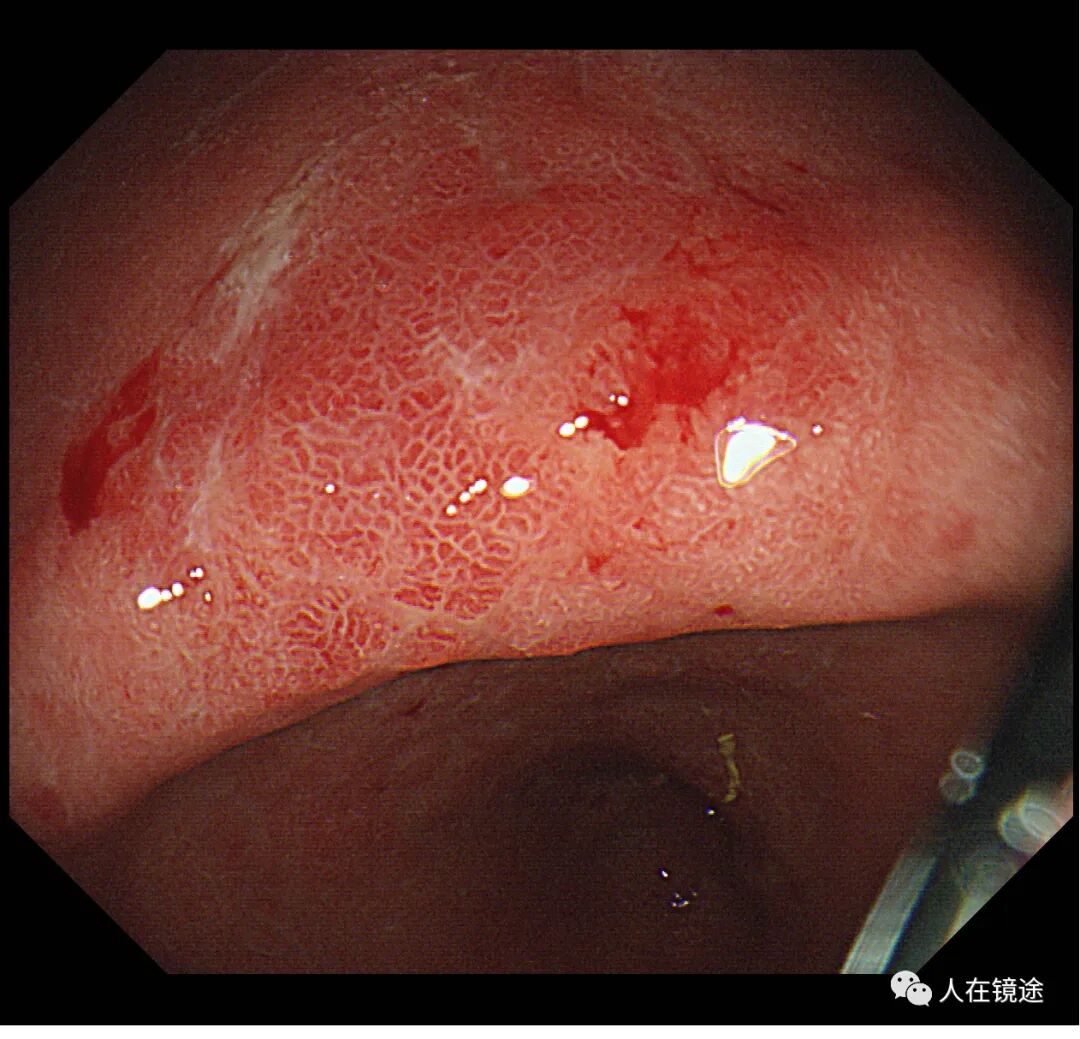 电子胃镜镜是什么奥林巴斯HQ290电子胃镜诊断胃窦早癌一例分享_https://www.jmylbn.com_新闻资讯_第9张