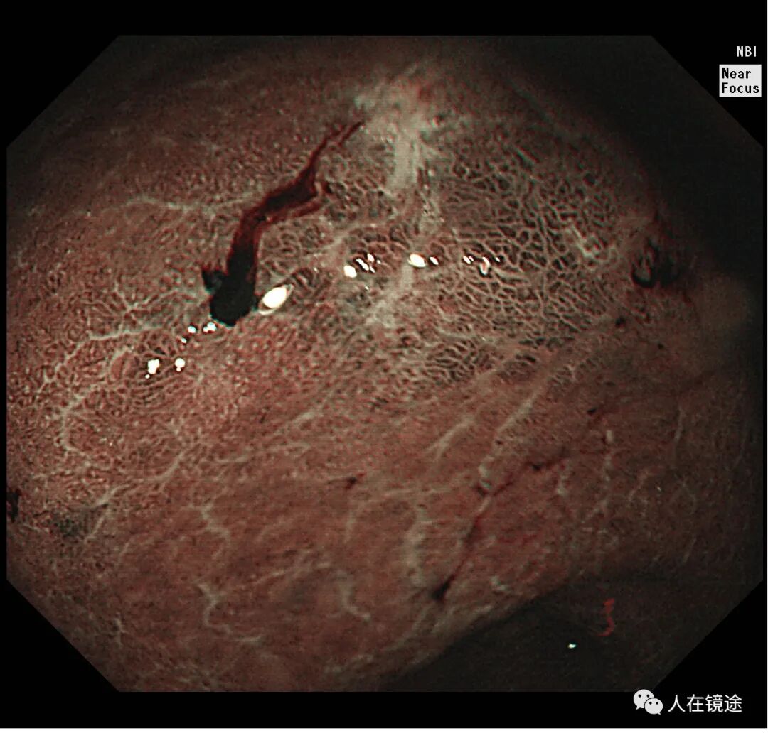 电子胃镜镜是什么奥林巴斯HQ290电子胃镜诊断胃窦早癌一例分享_https://www.jmylbn.com_新闻资讯_第19张