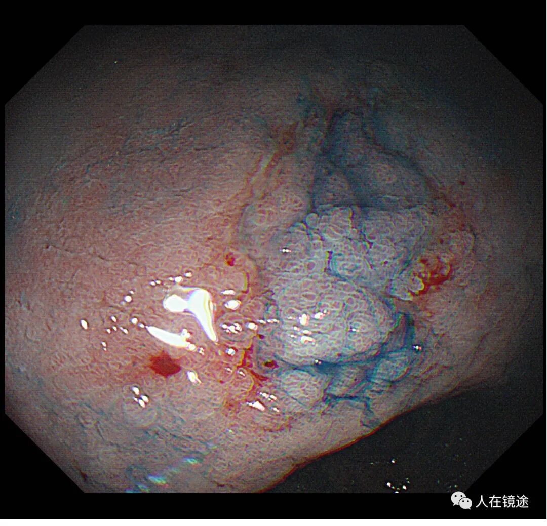 电子胃镜镜是什么奥林巴斯HQ290电子胃镜诊断胃窦早癌一例分享_https://www.jmylbn.com_新闻资讯_第26张
