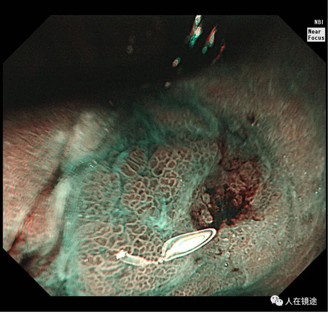 电子胃镜镜是什么奥林巴斯HQ290电子胃镜诊断胃窦早癌一例分享_https://www.jmylbn.com_新闻资讯_第22张