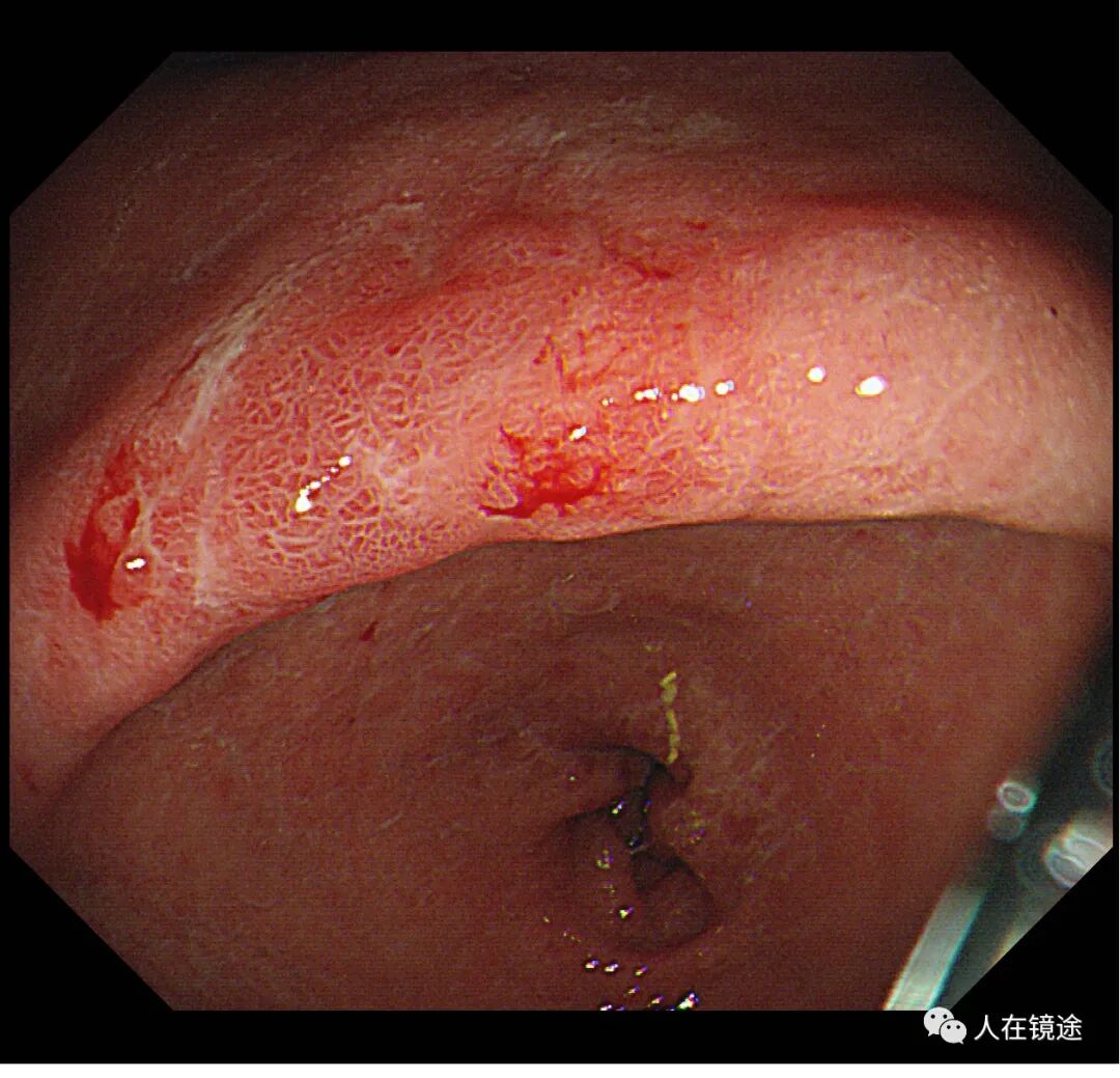 电子胃镜镜是什么奥林巴斯HQ290电子胃镜诊断胃窦早癌一例分享_https://www.jmylbn.com_新闻资讯_第4张