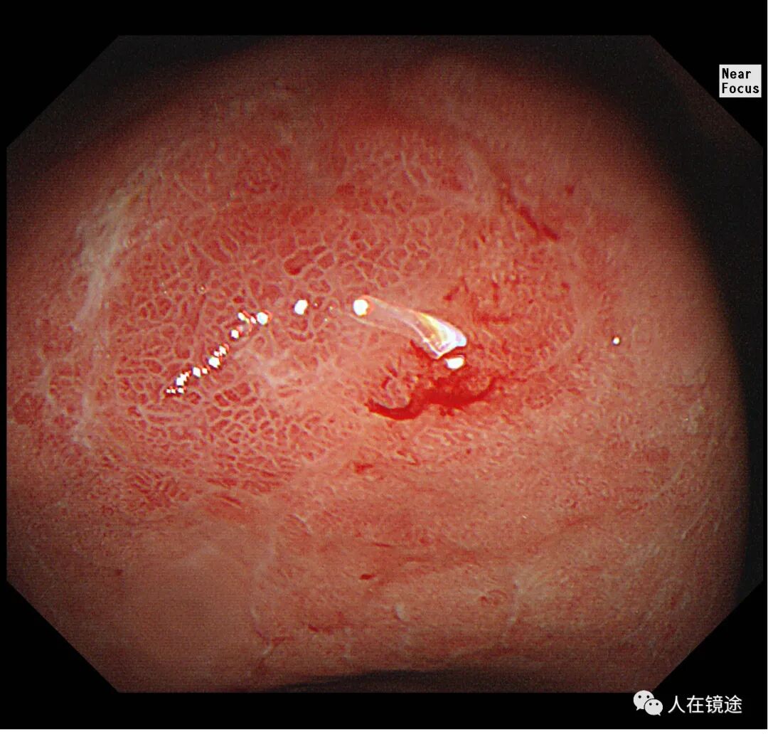 电子胃镜镜是什么奥林巴斯HQ290电子胃镜诊断胃窦早癌一例分享_https://www.jmylbn.com_新闻资讯_第12张