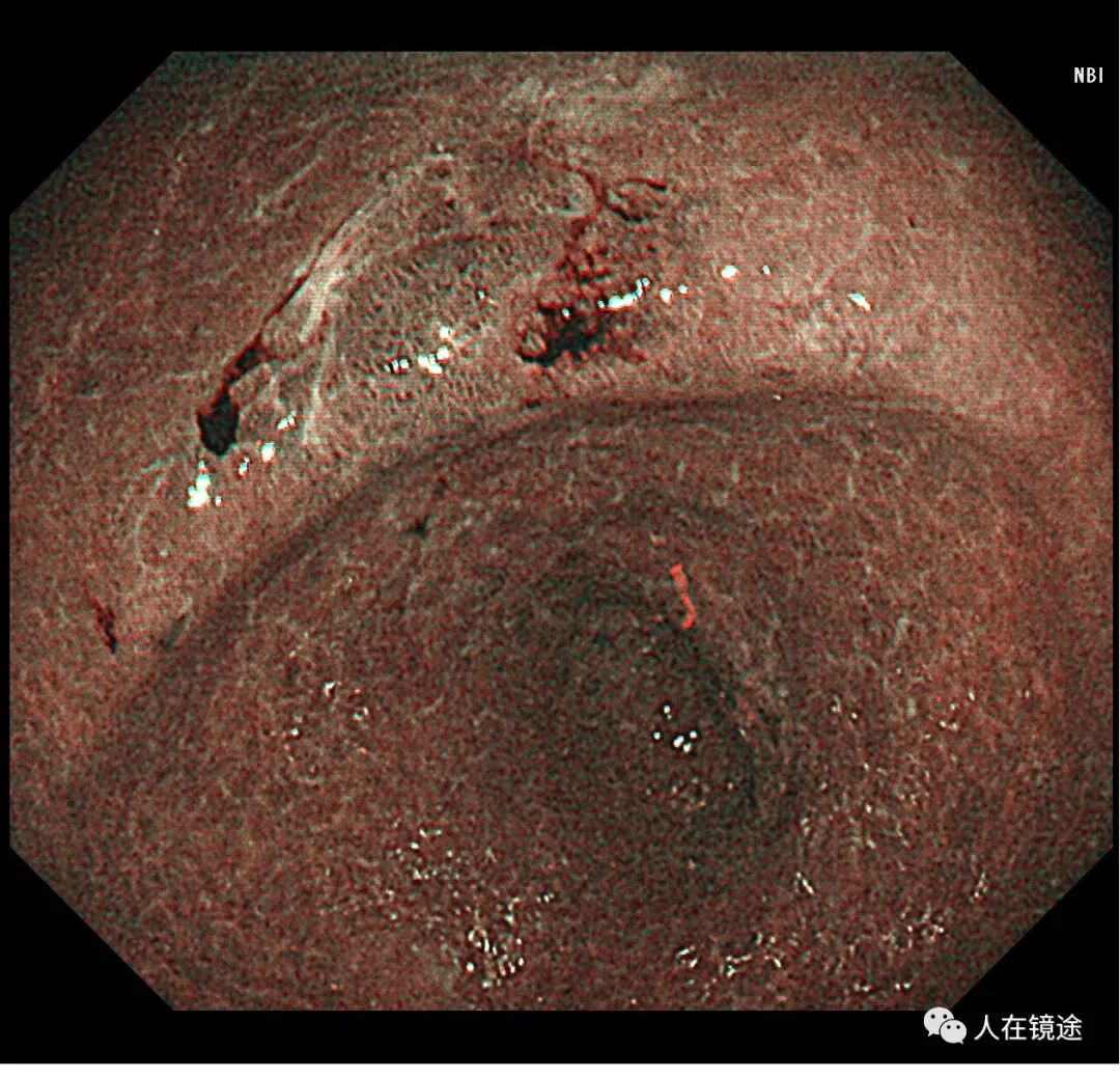 电子胃镜镜是什么奥林巴斯HQ290电子胃镜诊断胃窦早癌一例分享_https://www.jmylbn.com_新闻资讯_第15张