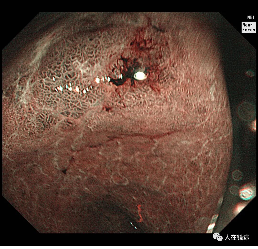 电子胃镜镜是什么奥林巴斯HQ290电子胃镜诊断胃窦早癌一例分享_https://www.jmylbn.com_新闻资讯_第18张