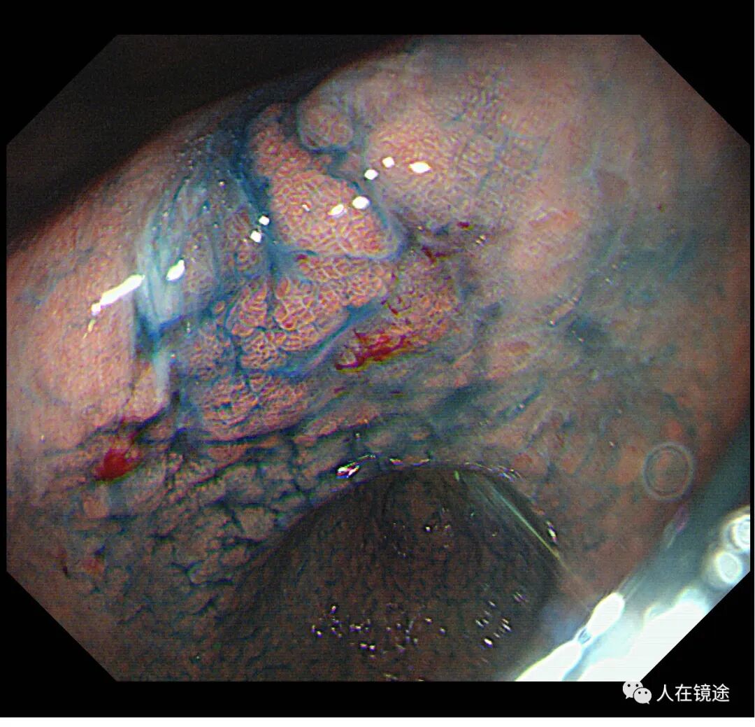 电子胃镜镜是什么奥林巴斯HQ290电子胃镜诊断胃窦早癌一例分享_https://www.jmylbn.com_新闻资讯_第21张