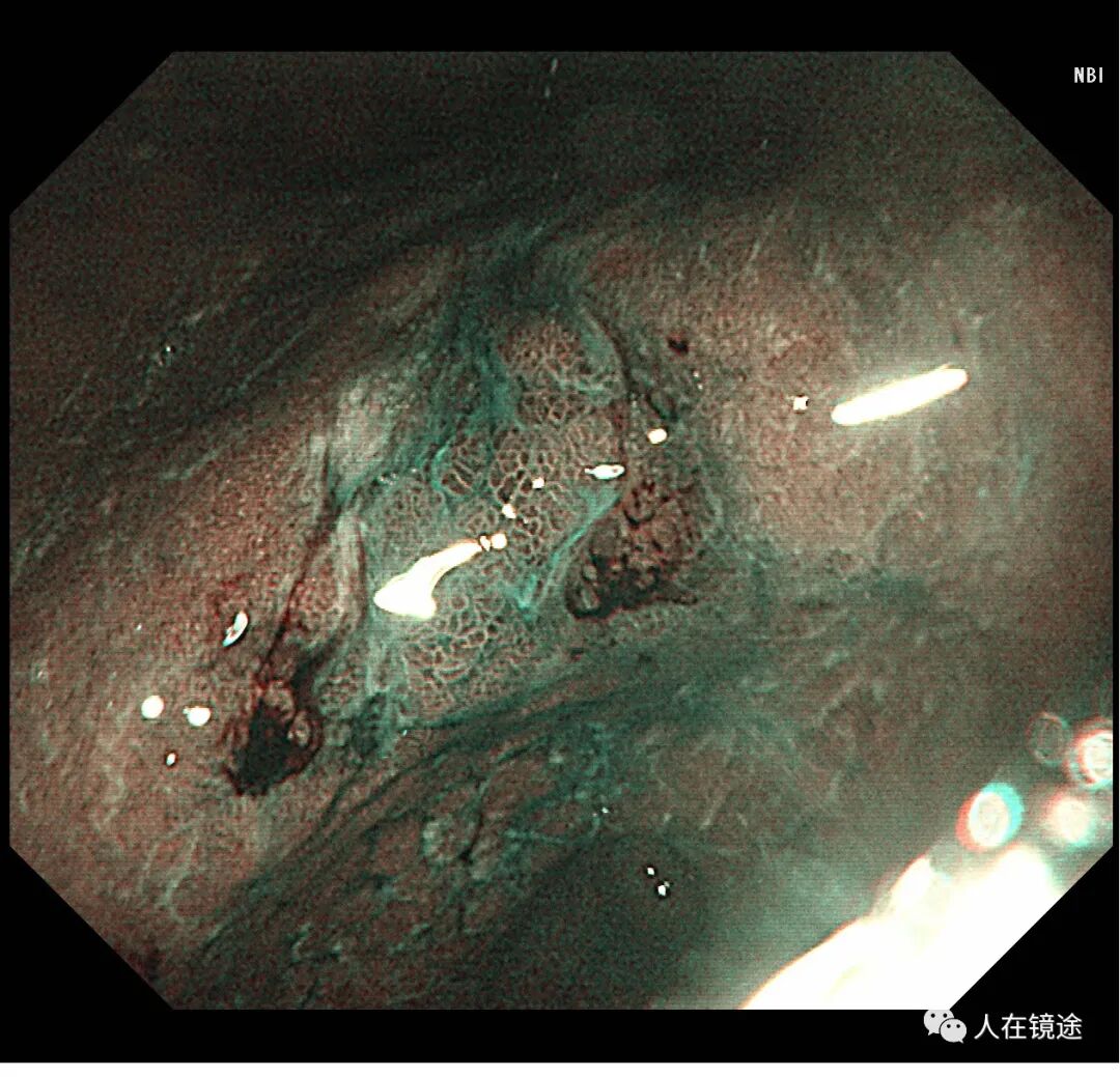 电子胃镜镜是什么奥林巴斯HQ290电子胃镜诊断胃窦早癌一例分享_https://www.jmylbn.com_新闻资讯_第23张