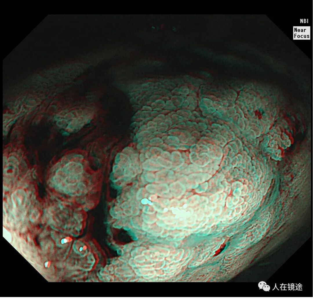 电子胃镜镜是什么奥林巴斯HQ290电子胃镜诊断胃窦早癌一例分享_https://www.jmylbn.com_新闻资讯_第29张
