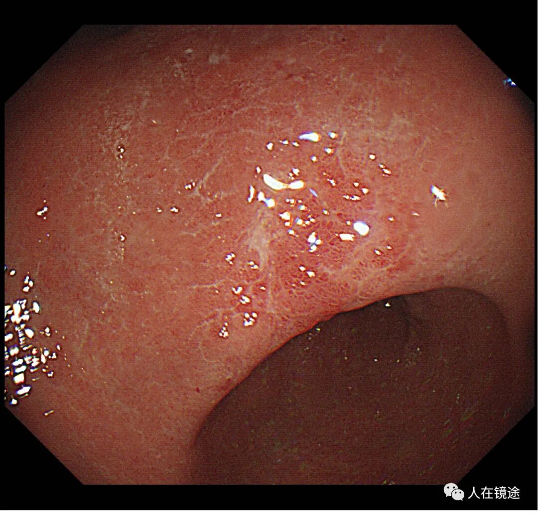 电子胃镜镜是什么奥林巴斯HQ290电子胃镜诊断胃窦早癌一例分享_https://www.jmylbn.com_新闻资讯_第3张