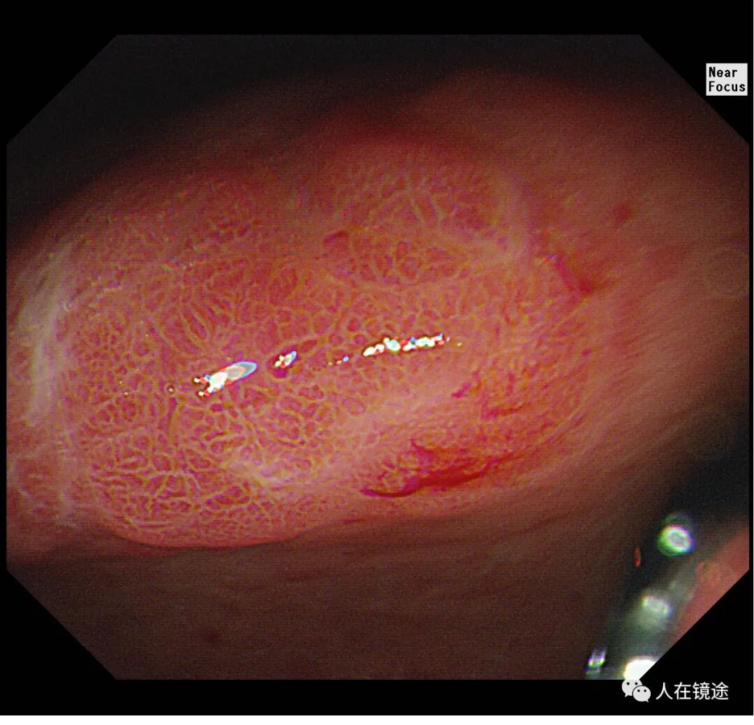 电子胃镜镜是什么奥林巴斯HQ290电子胃镜诊断胃窦早癌一例分享_https://www.jmylbn.com_新闻资讯_第13张