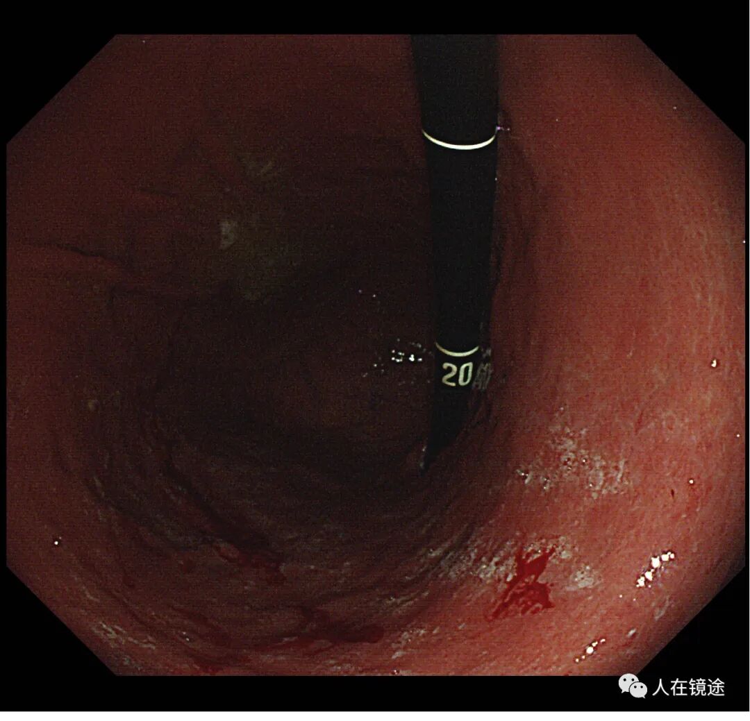 电子胃镜镜是什么奥林巴斯HQ290电子胃镜诊断胃窦早癌一例分享_https://www.jmylbn.com_新闻资讯_第7张