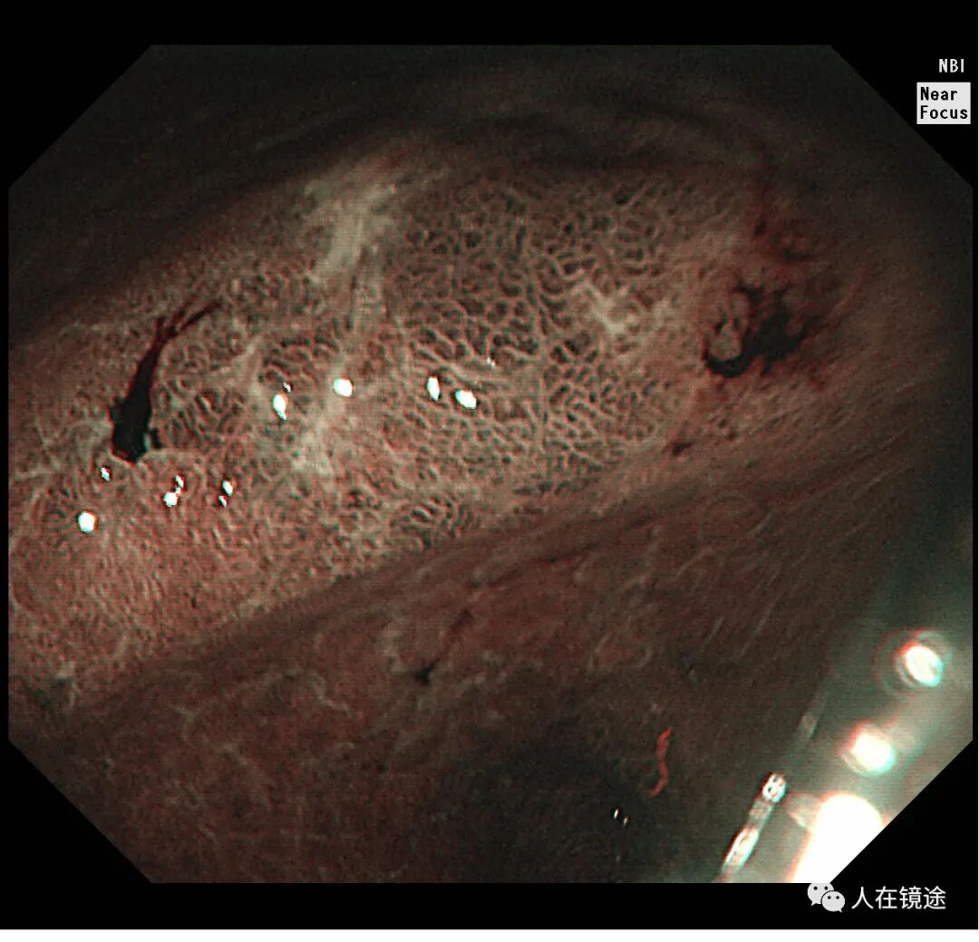电子胃镜镜是什么奥林巴斯HQ290电子胃镜诊断胃窦早癌一例分享_https://www.jmylbn.com_新闻资讯_第17张
