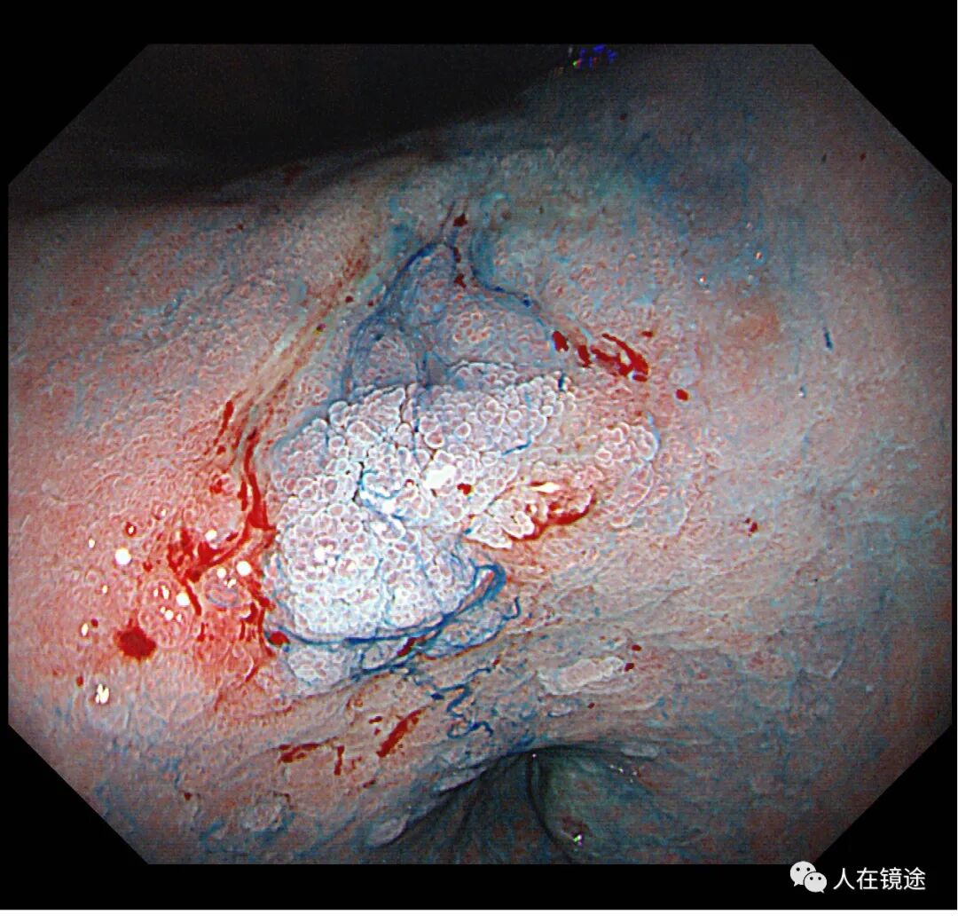 电子胃镜镜是什么奥林巴斯HQ290电子胃镜诊断胃窦早癌一例分享_https://www.jmylbn.com_新闻资讯_第24张