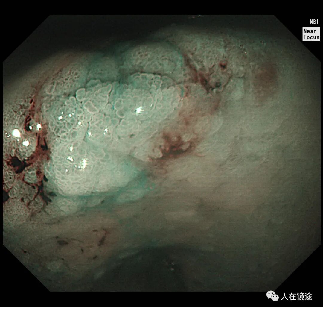 电子胃镜镜是什么奥林巴斯HQ290电子胃镜诊断胃窦早癌一例分享_https://www.jmylbn.com_新闻资讯_第31张