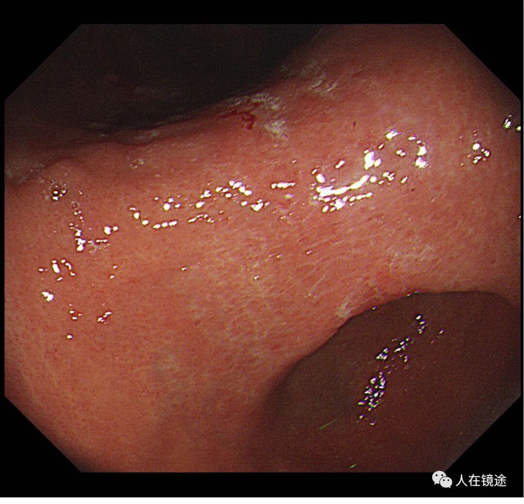 电子胃镜镜是什么奥林巴斯HQ290电子胃镜诊断胃窦早癌一例分享_https://www.jmylbn.com_新闻资讯_第6张