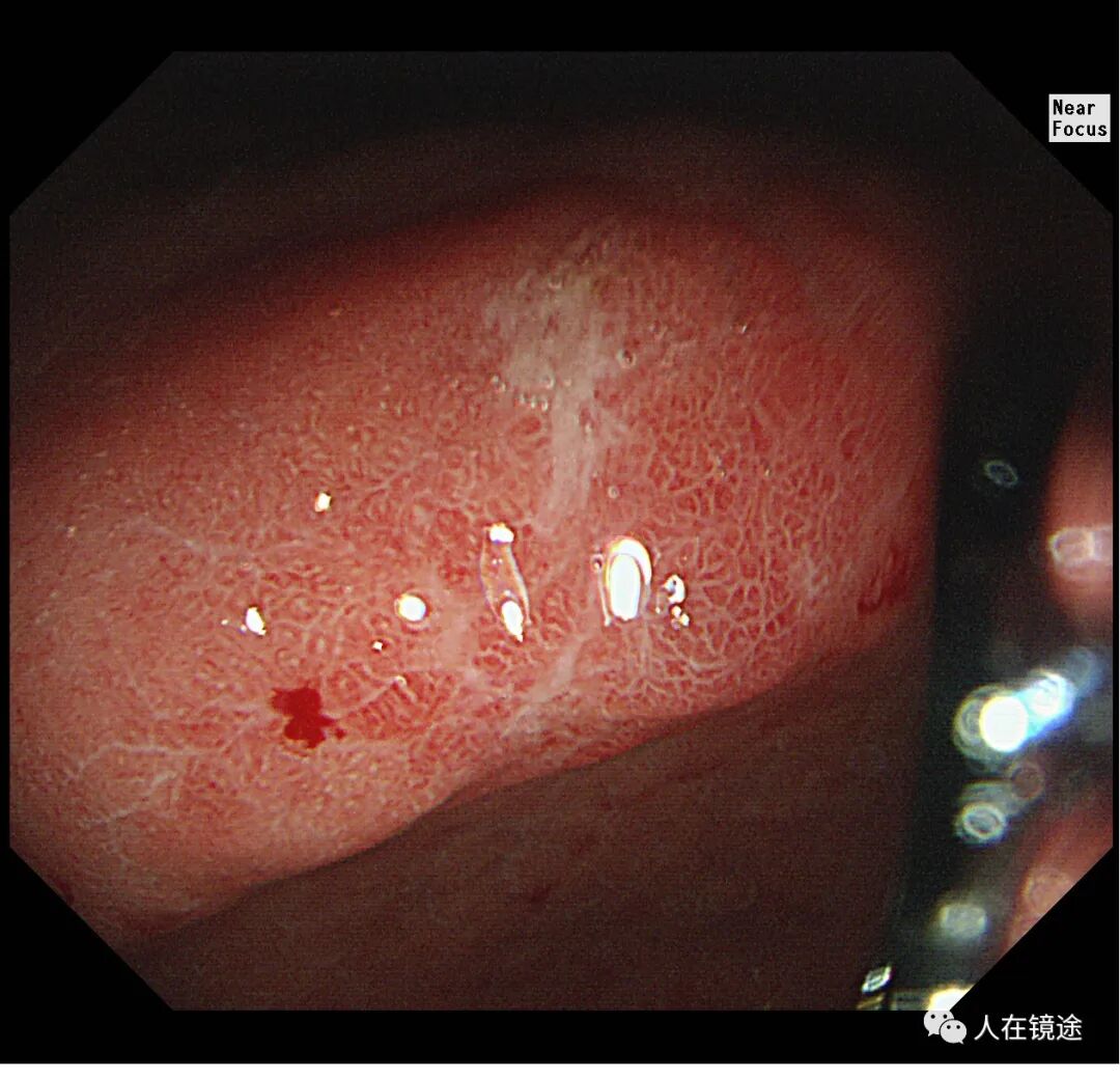 电子胃镜镜是什么奥林巴斯HQ290电子胃镜诊断胃窦早癌一例分享_https://www.jmylbn.com_新闻资讯_第14张
