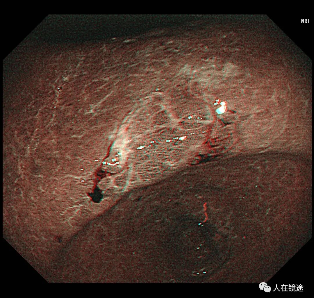 电子胃镜镜是什么奥林巴斯HQ290电子胃镜诊断胃窦早癌一例分享_https://www.jmylbn.com_新闻资讯_第16张