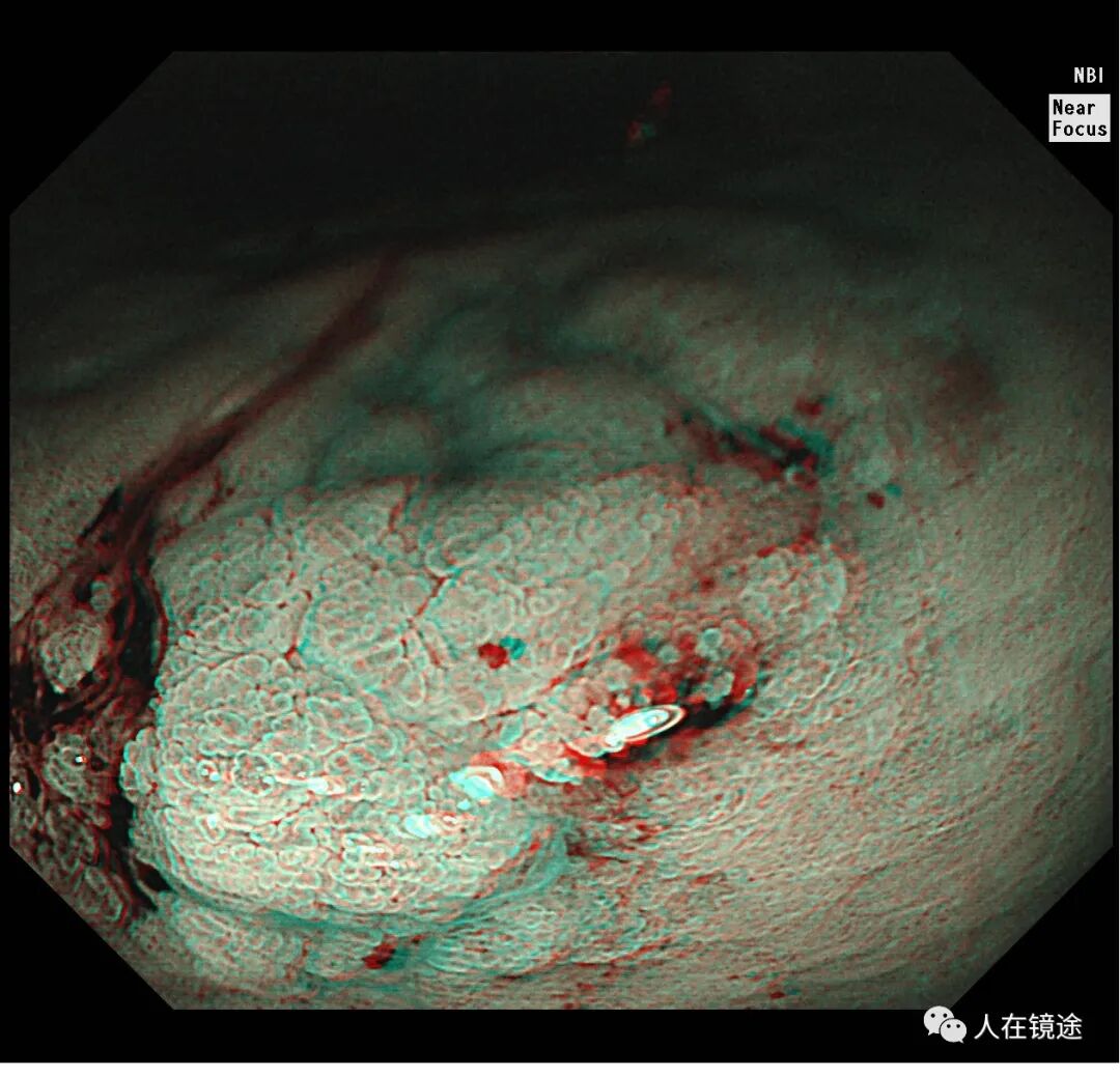 电子胃镜镜是什么奥林巴斯HQ290电子胃镜诊断胃窦早癌一例分享_https://www.jmylbn.com_新闻资讯_第28张