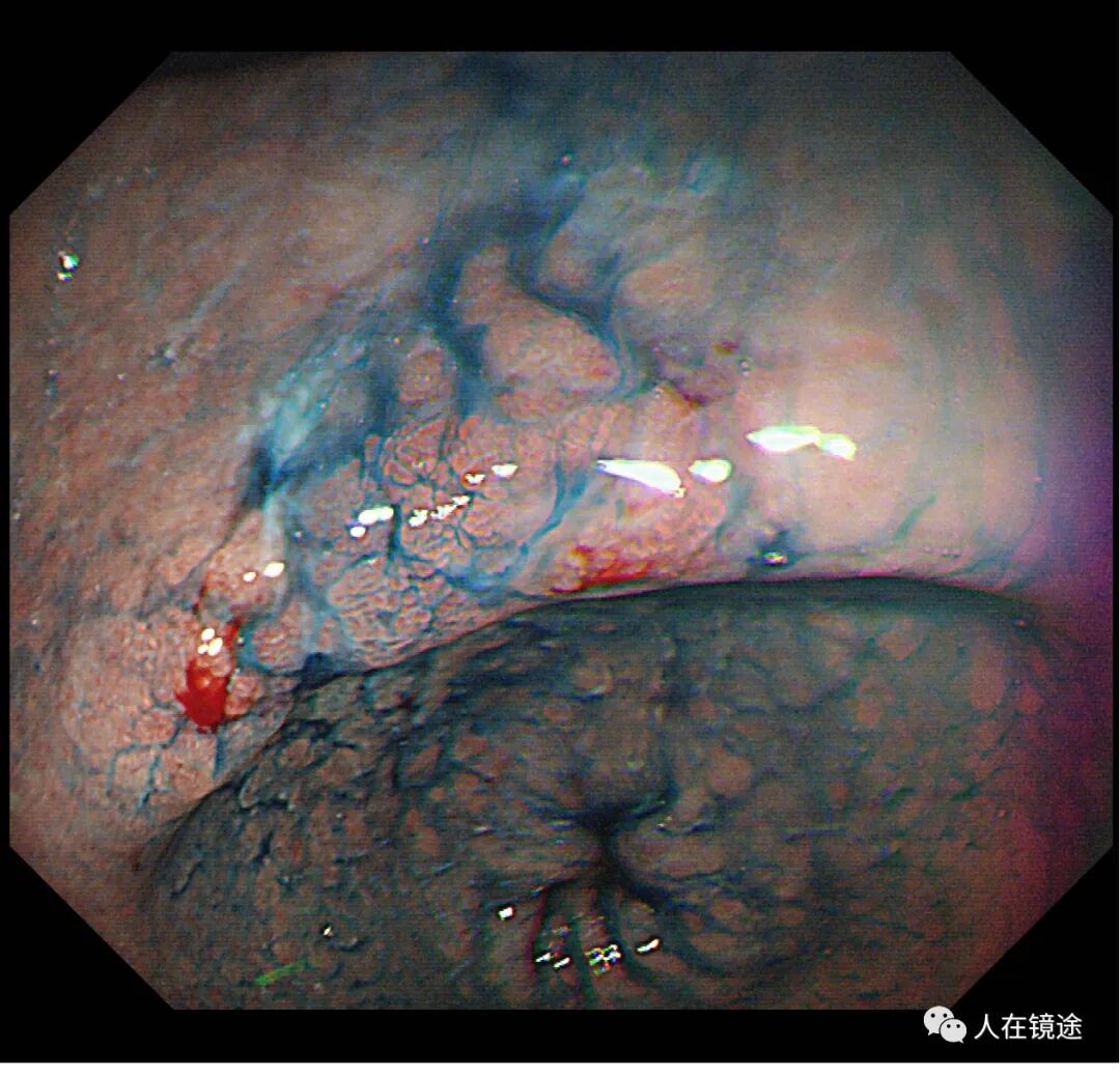 电子胃镜镜是什么奥林巴斯HQ290电子胃镜诊断胃窦早癌一例分享_https://www.jmylbn.com_新闻资讯_第20张