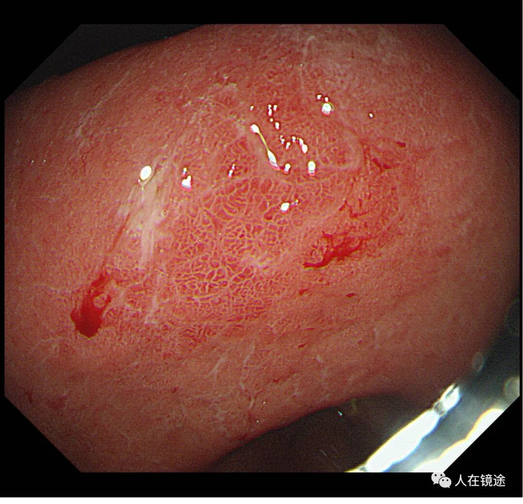 电子胃镜镜是什么奥林巴斯HQ290电子胃镜诊断胃窦早癌一例分享_https://www.jmylbn.com_新闻资讯_第11张