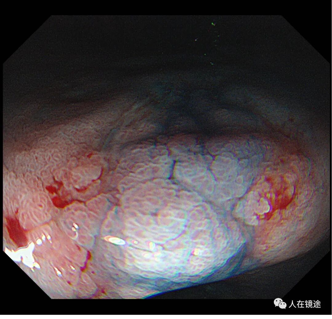 电子胃镜镜是什么奥林巴斯HQ290电子胃镜诊断胃窦早癌一例分享_https://www.jmylbn.com_新闻资讯_第25张
