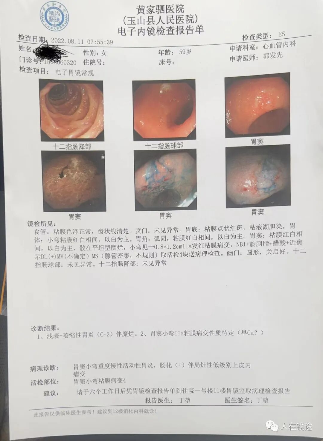 电子胃镜镜是什么奥林巴斯HQ290电子胃镜诊断胃窦早癌一例分享_https://www.jmylbn.com_新闻资讯_第32张