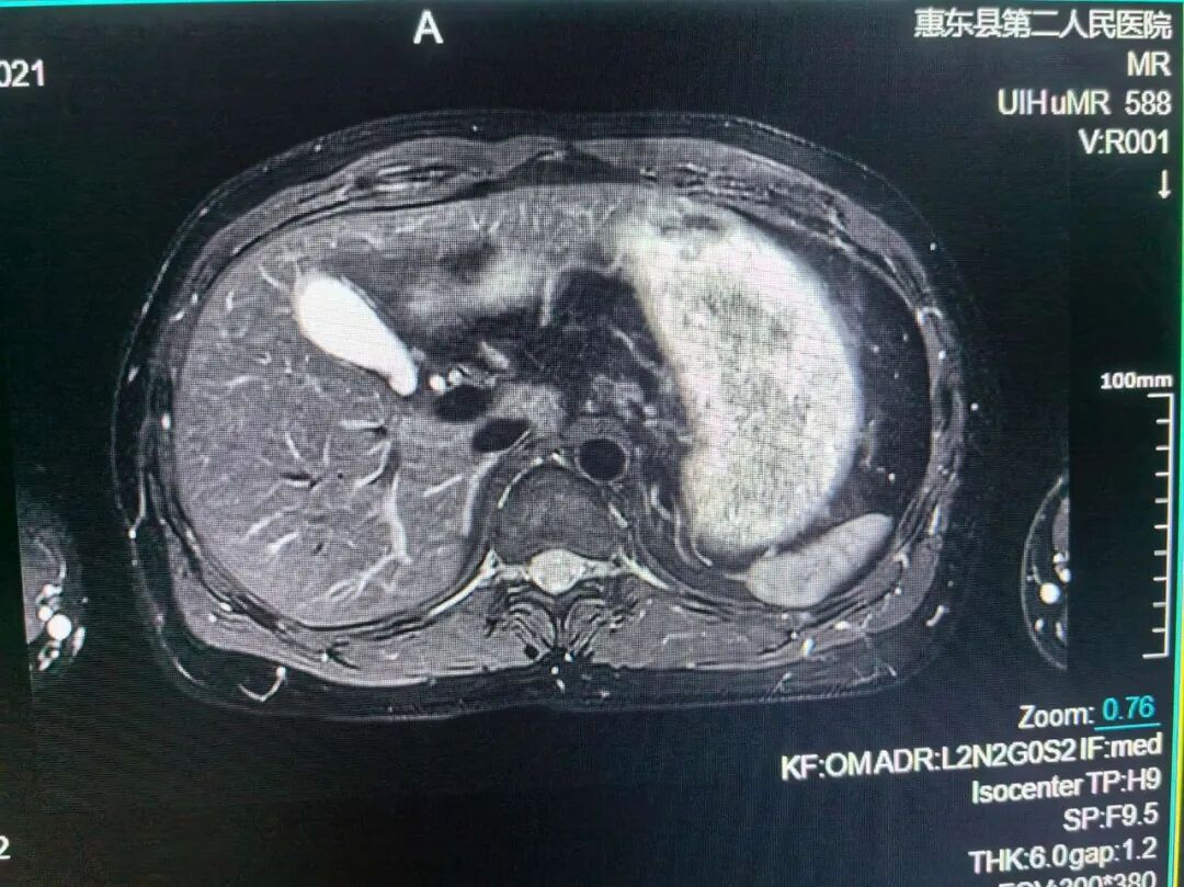 联影的磁共振怎么样号外！号外！！惠东县第二人民医院引进联影1.5T磁共振设备_https://www.jmylbn.com_新闻资讯_第11张