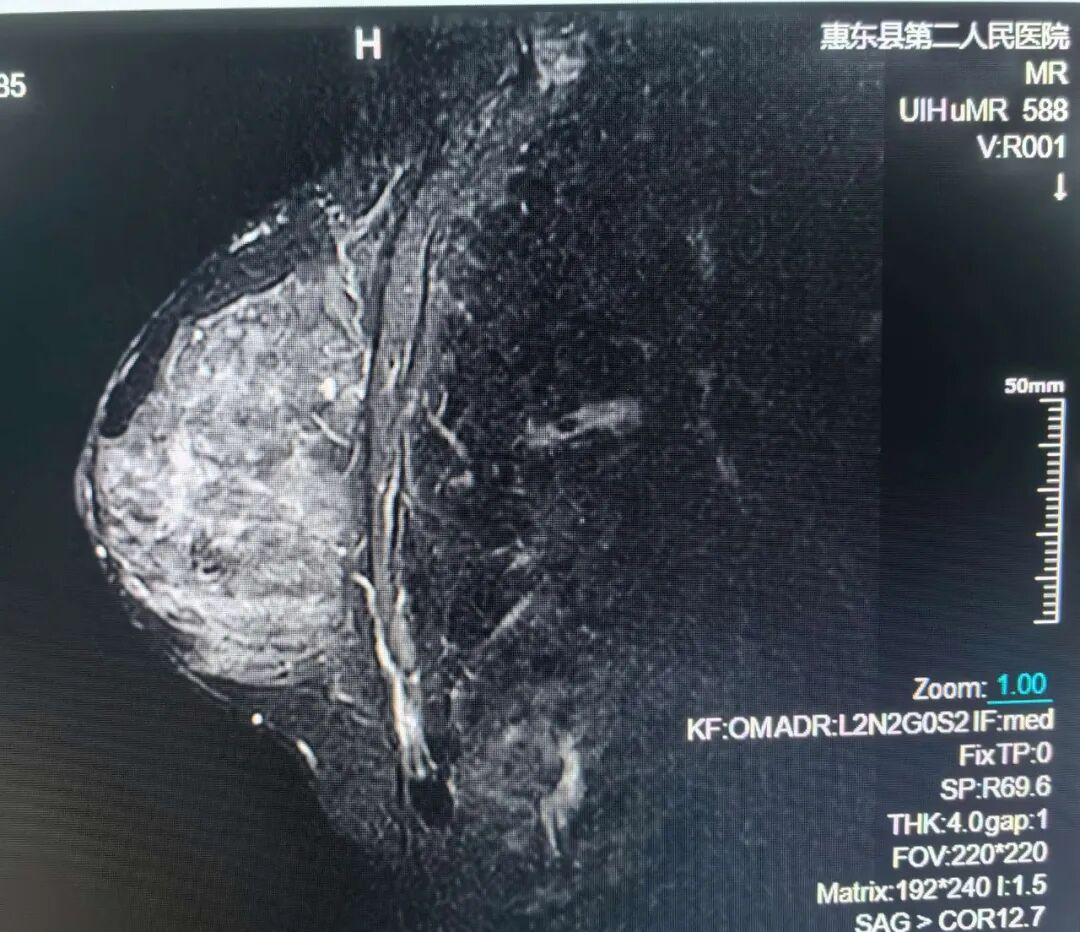 联影的磁共振怎么样号外！号外！！惠东县第二人民医院引进联影1.5T磁共振设备_https://www.jmylbn.com_新闻资讯_第9张