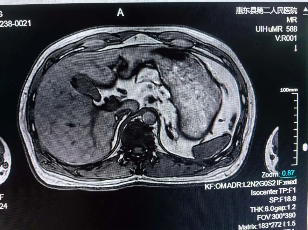 联影的磁共振怎么样号外！号外！！惠东县第二人民医院引进联影1.5T磁共振设备_https://www.jmylbn.com_新闻资讯_第12张