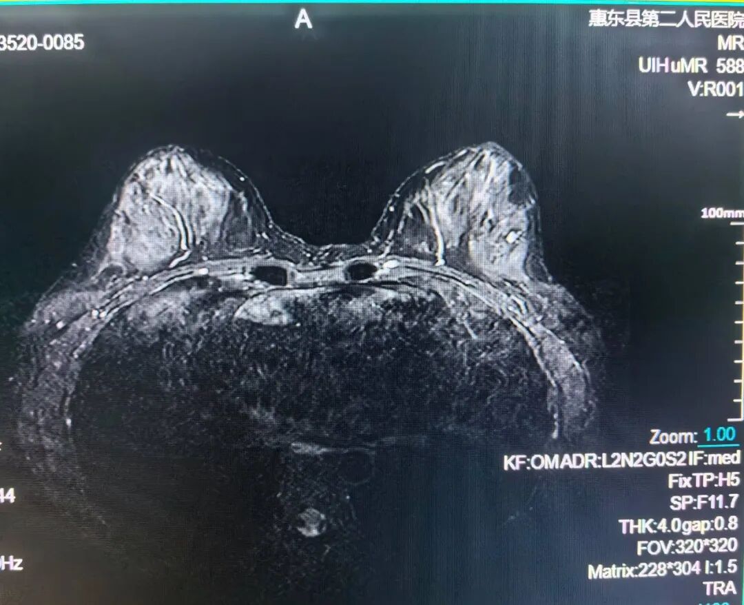 联影的磁共振怎么样号外！号外！！惠东县第二人民医院引进联影1.5T磁共振设备_https://www.jmylbn.com_新闻资讯_第10张