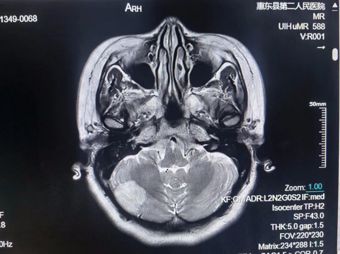 联影的磁共振怎么样号外！号外！！惠东县第二人民医院引进联影1.5T磁共振设备_https://www.jmylbn.com_新闻资讯_第6张
