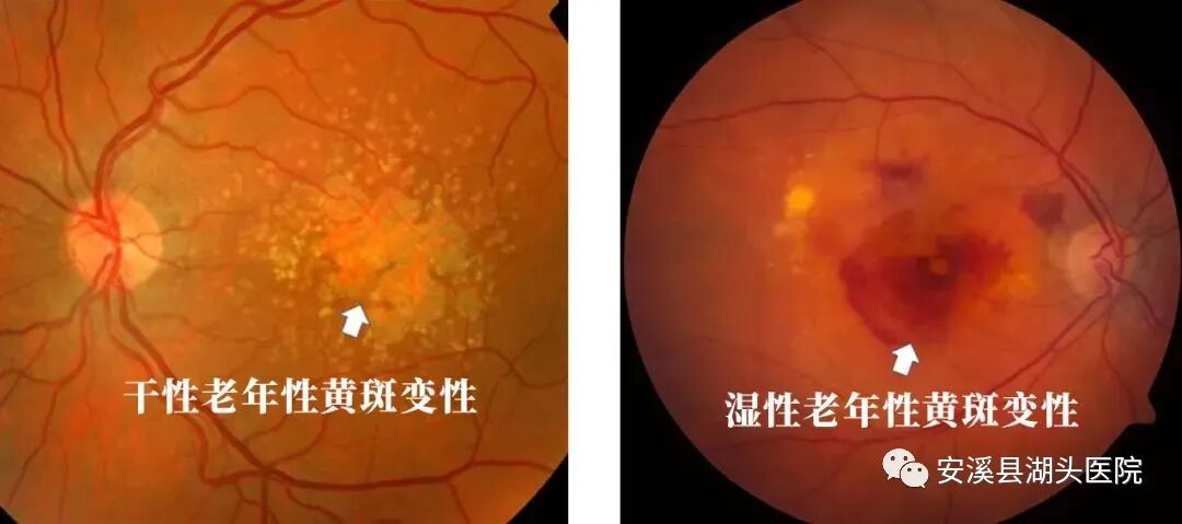 眼底照相有什么用【“视”关重要】眼底一张照，眼病早知道！_https://www.jmylbn.com_新闻资讯_第11张