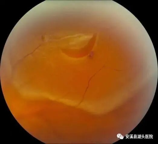 眼底照相有什么用【“视”关重要】眼底一张照，眼病早知道！_https://www.jmylbn.com_新闻资讯_第8张