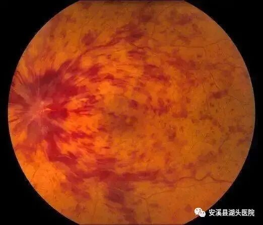 眼底照相有什么用【“视”关重要】眼底一张照，眼病早知道！_https://www.jmylbn.com_新闻资讯_第6张
