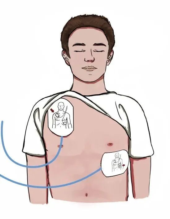 aed电极贴怎么贴急救知识 ｜ 如何正确使用AED？_https://www.jmylbn.com_新闻资讯_第7张